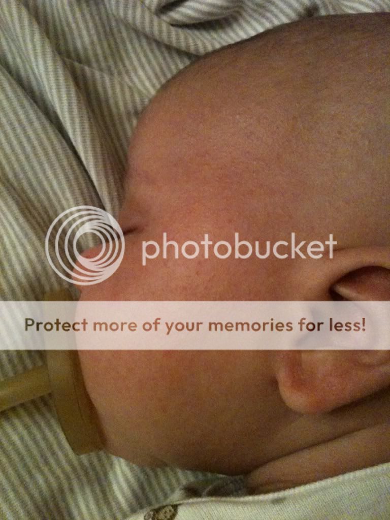 Red Bumps Heat Rash Baby Face Heat Rash on face Pictures, Baby, Bumps